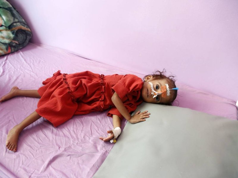 WHO: Campak telah membunuh 413 anak di Yaman