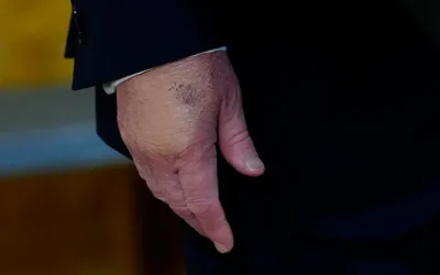 Viral! Tangan Lebam Trump Picu Spekulasi, Ada yang Disembunyikan?