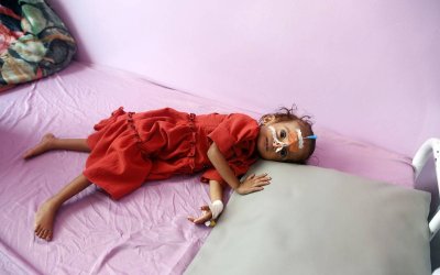 WHO: Campak telah membunuh 413 anak di Yaman