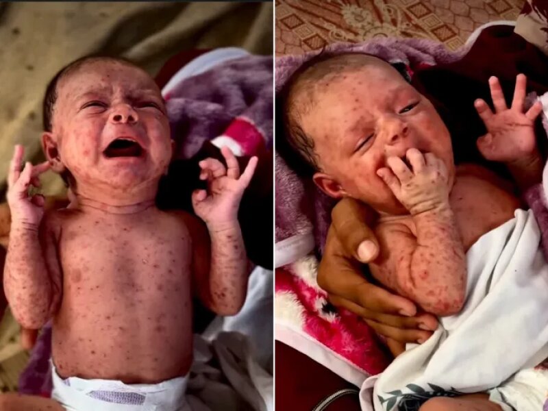 Wabah Cacar Air Lumpuhkan Kamp Pengungsian Gaza