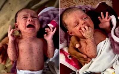 Wabah Cacar Air Lumpuhkan Kamp Pengungsian Gaza