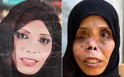 "Anak-anakku Takut Melihat Wajahku": Kisah Pilu Ibu Gaza yang Wajahnya Hancur akibat Serangan "Israel"